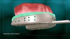 Veneers (Impression) 004