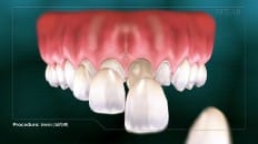 Veneers image 005