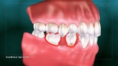 Single Tooth Loss 006