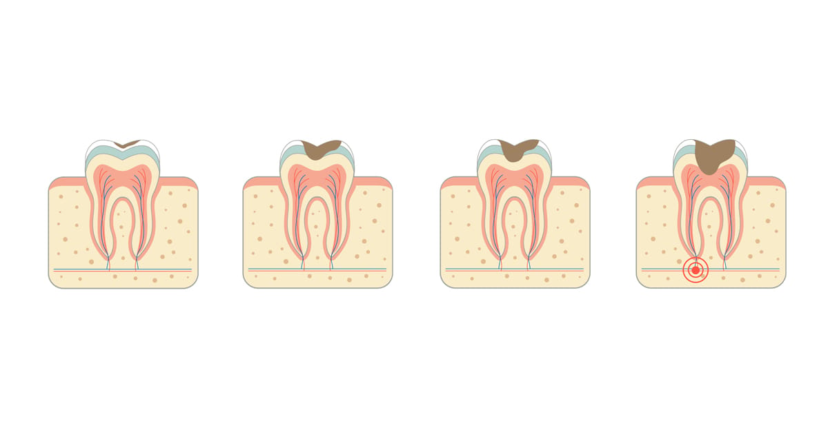 Debunk Cavity Myths to Improve your Pediatric Dental Knowledge