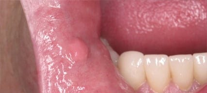 Fibroma-Res1