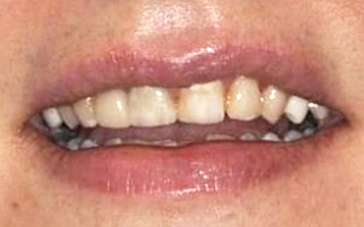 18. Patient EF (10 teeth)_ Porcelain crowns on upper 10 teeth Before