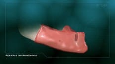 Locator Retained Overdenture 008