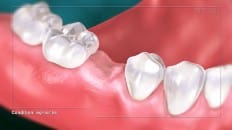 Single Tooth Loss 001
