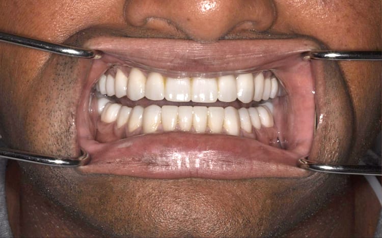 26. Patient VB (all 28 teeth) _ 14 upper porcelain crowns and 14 lower porcelain crowns After