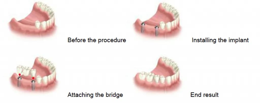 Bridges procedure Illustration