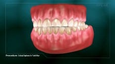 Occlusal Appliance For Tooth Wear 005
