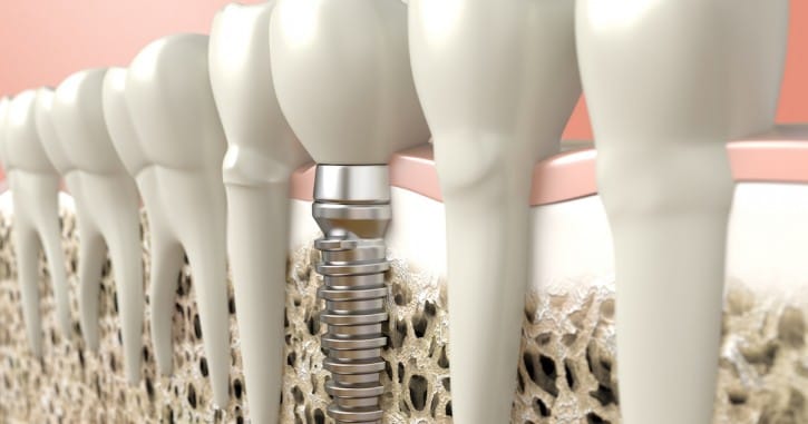 See Why a Dental implant is the Preferred Permanent Tooth Replacement Solution See Why a Dental implant is the Preferred Permanent Tooth Replacement Solution