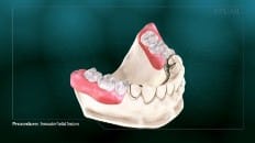 Removable Partial Dentures 004