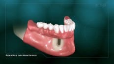 Locator Retained Overdenture 003