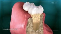 Gingival Probing And Pocket Depth 002
