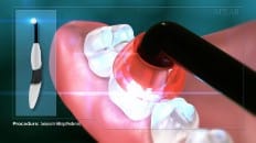 Composite Filling (Posterior) 004