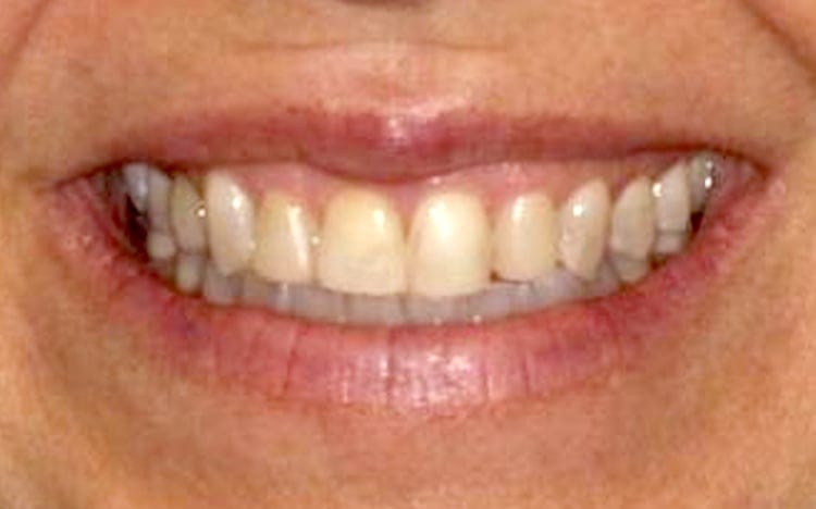 7. Patient MB (4 teeth)_ 4 porcelain veneers on front teeth Before