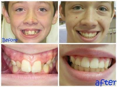Before and After