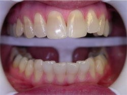 Zoom Whitening after