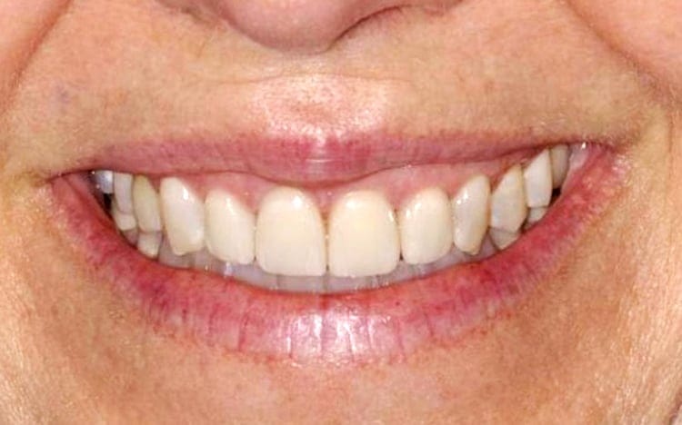 7. Patient MB (4 teeth)_ 4 porcelain veneers on front teeth After