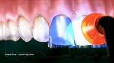Composite Filling (Anterior) 005