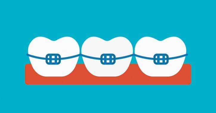 Are Removable Braces Right for You?