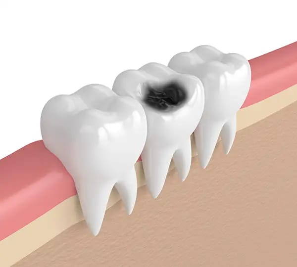 Dead tooth with visible decay showing need for dental intervention