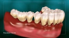 Periodontitis 003