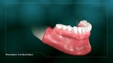 Screw Retained Dentures 006