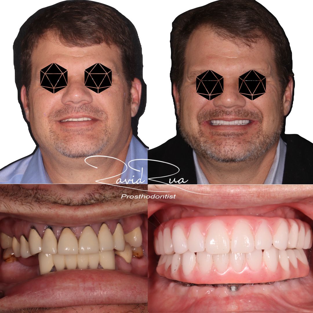 TC Cape Coral Case 5 All on 6-7 implant hybrids