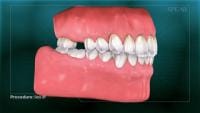 Sinus Lift 001