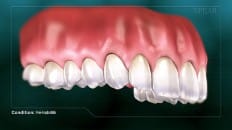 Peri-Implantitis 005