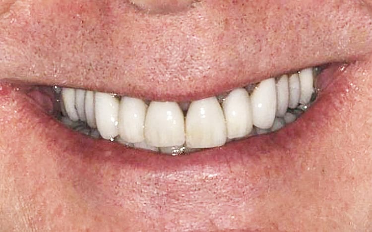 17. Patient MS (10 teeth)_ Porcelain crowns on upper 10 teeth Before