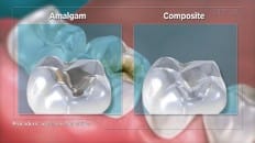 Composite Versus Amalgam Filling 001