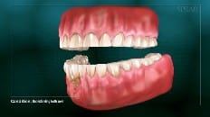 Understanding Tooth Wear 007