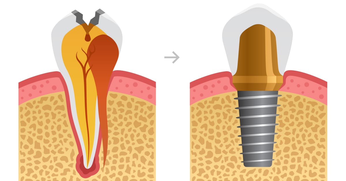 Are you a Candidate for the Most Affordable Dental Implants Dentists Offer?