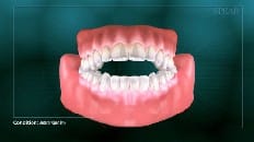 Anterior Open Bite 001
