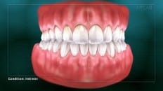 Dental Erosion 006