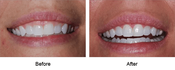 Smile Galley Before and After