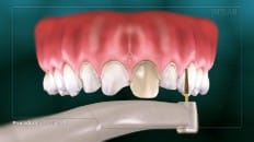 Veneers image 003