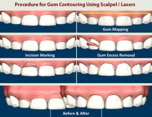 Gum recounting procedure