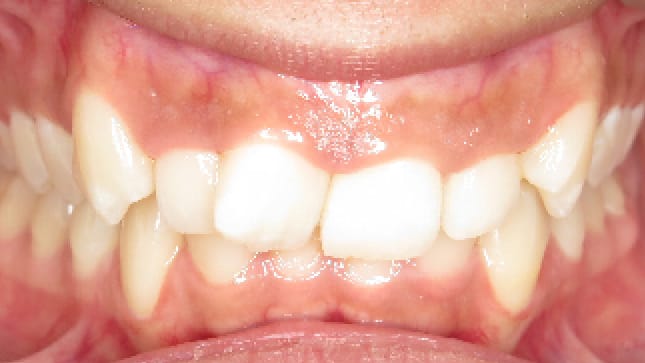 BF Ortho Smile Gallery Before