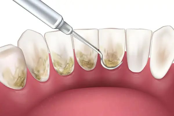 Dental scaling procedure for gum disease treatment and LANAP therapy