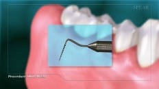 Gingival Probing And Pocket Depth 003