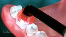 Composite Versus Amalgam Filling 006