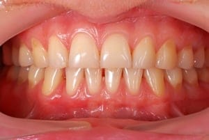 Did prehistoric humans have better teeth than us? Did prehistoric humans have better teeth than us?