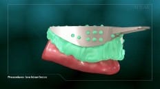 Screw Retained Dentures 003