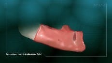 Locator Retained Overdenture (Reline) 006