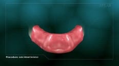 Locator Retained Overdenture 001