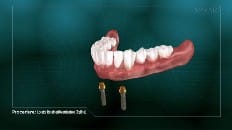 Locator Retained Overdenture (Reline) 004