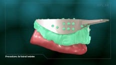 Bar Retained Overdenture 005