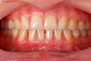 Tips for preventing receding gums Tips for preventing receding gums