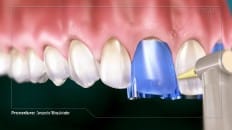 Composite Filling (Anterior) 006