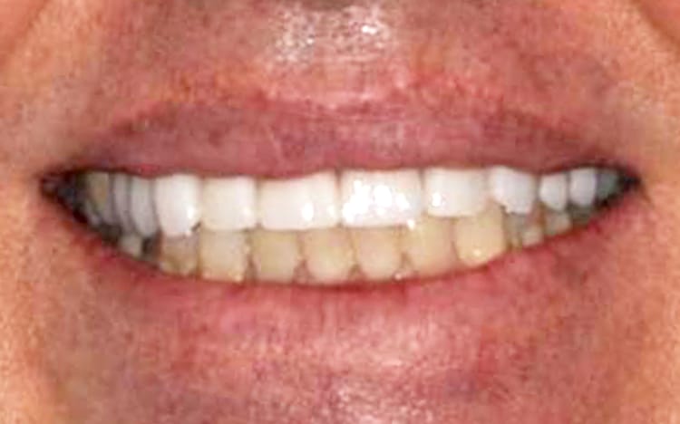 16. Patient KS (10 teeth)_ Porcelain crowns on upper 10 teeth After